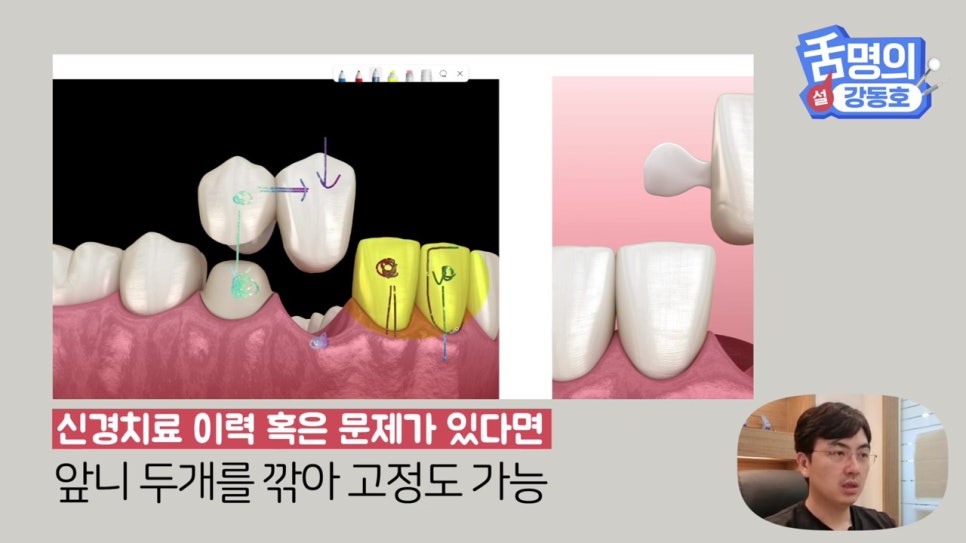 신림동치과, 브릿지치료 치아삭제 부담된다면? 관련 이미지 12