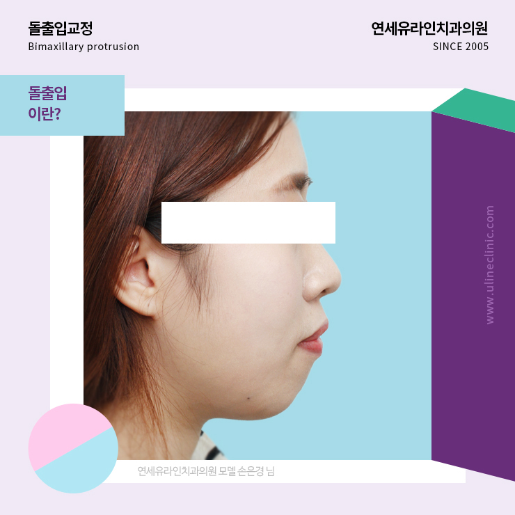 봉천동치과 돌출입교정 잡아주러 왔다 관련 이미지 1