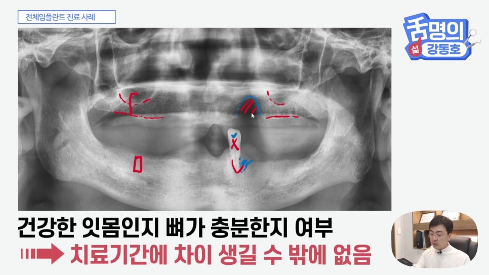 관악구치과 - 전체 임플란트, 시간&middot;횟수&middot;개수 총정리 관련 이미지 12