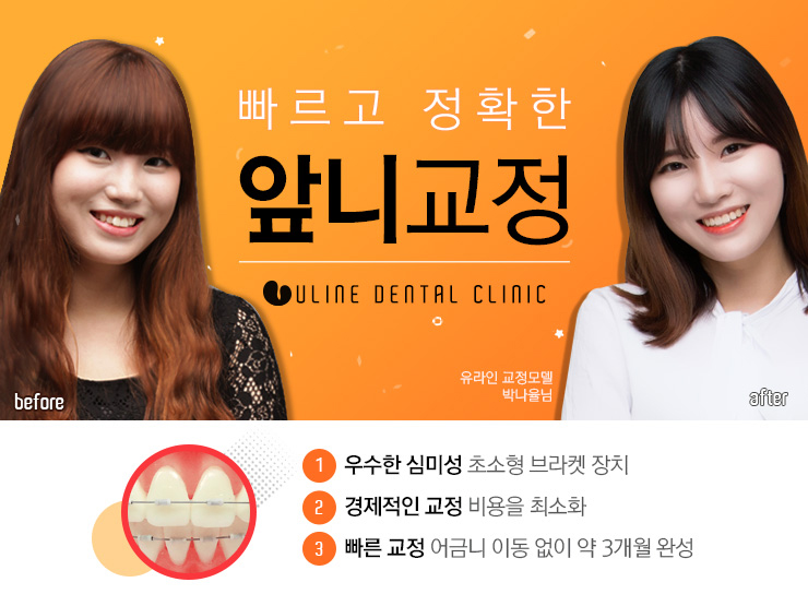 앞니교정후기 빠르니까 저렴하니까 관련 이미지 5