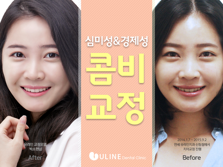 치아교정 종류 고민이시라면 이건어때요!? 관련 이미지 6