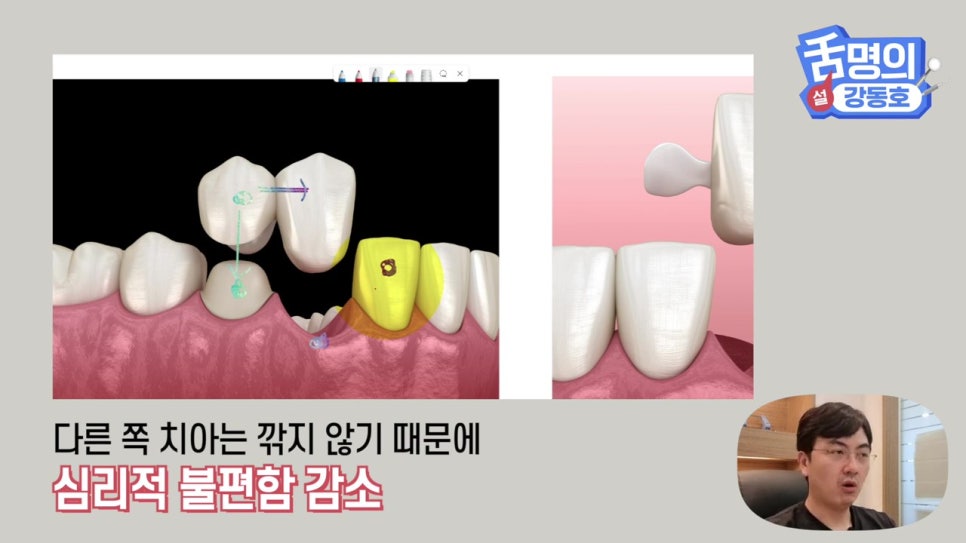 신림동치과, 브릿지치료 치아삭제 부담된다면? 관련 이미지 8