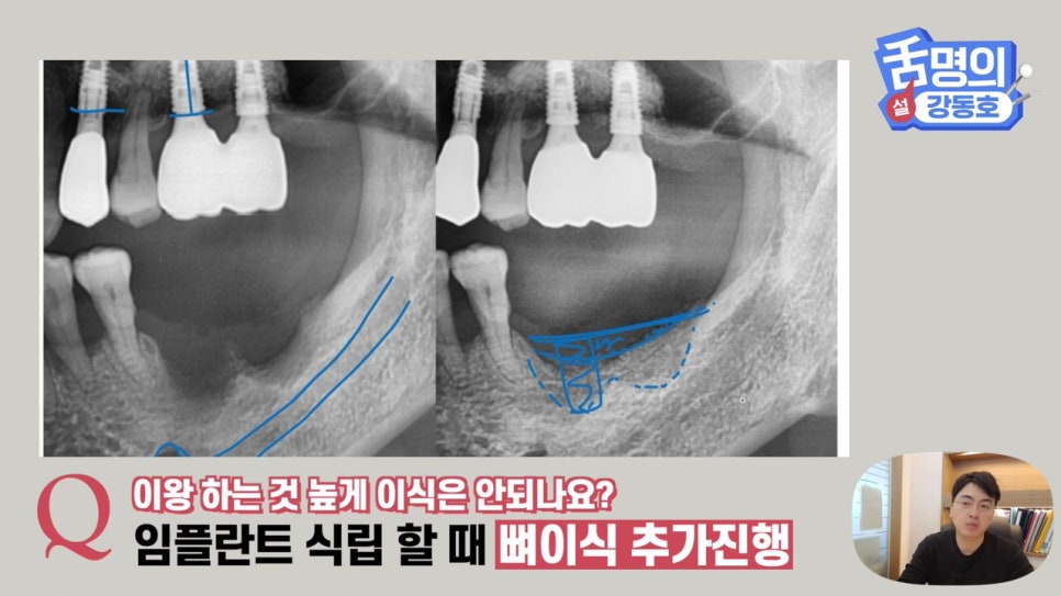 강남역임플란트, 뼈이식 왜 필요해? 관련 이미지 24