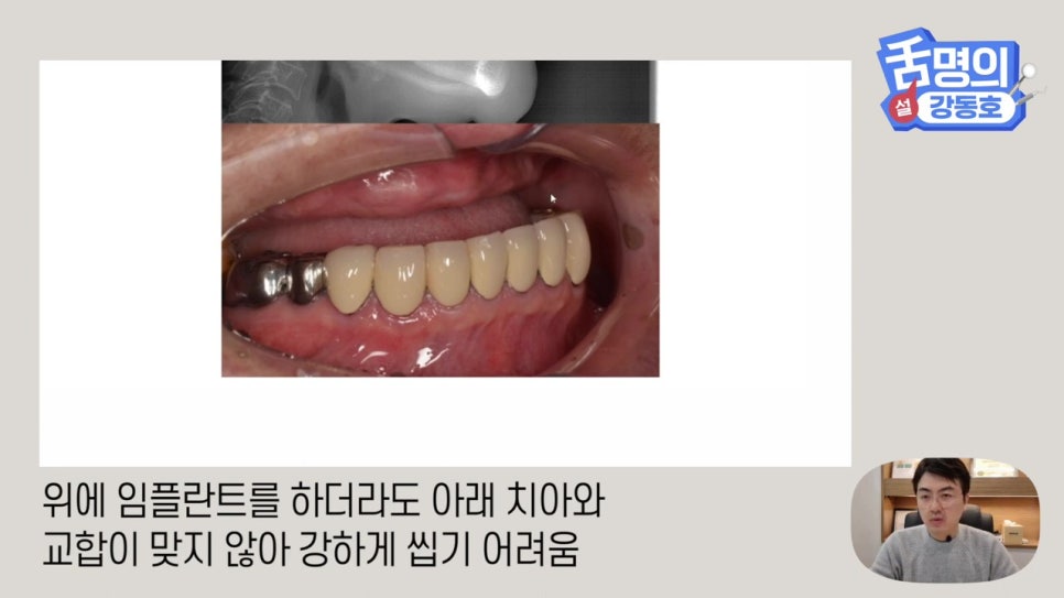신림동치과, 다수의 치아상실 후.. 관련 이미지 7