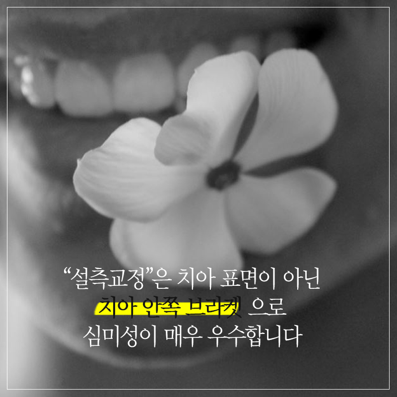 설측교정후기 반해버릴껄! 관련 이미지 7