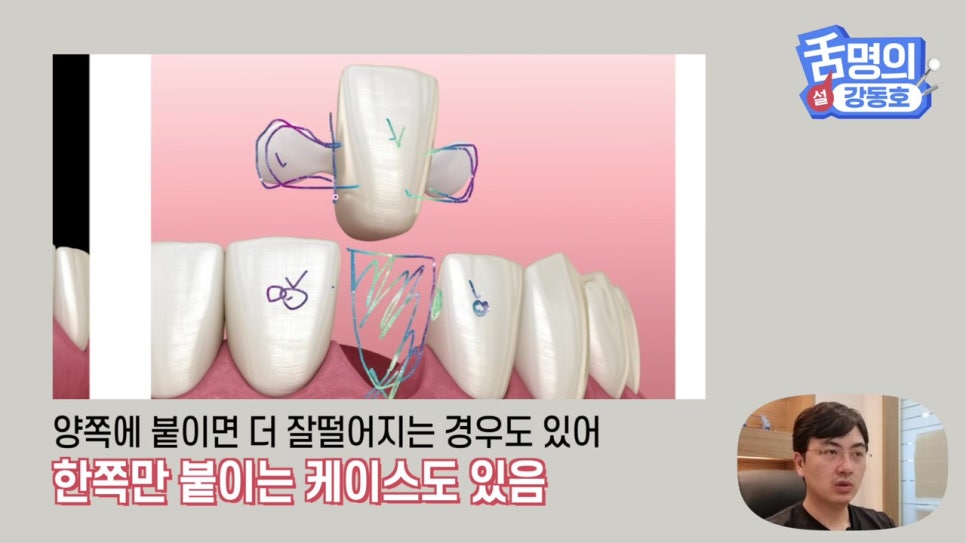 신림동치과, 브릿지치료 치아삭제 부담된다면? 관련 이미지 21