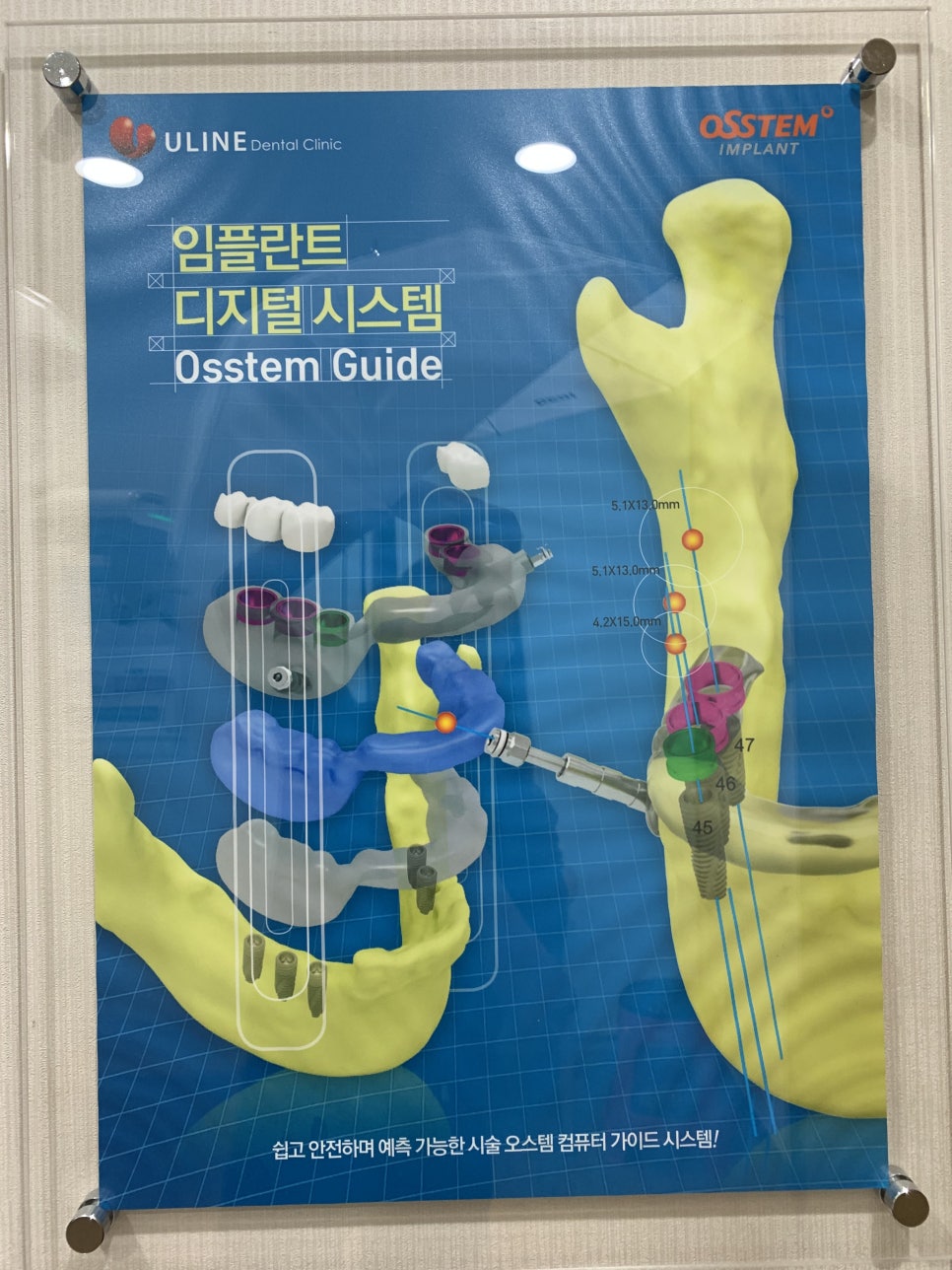노인임플란트비용 다시 씹는거야 관련 이미지 2