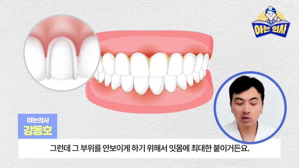 무삭제라미네이트, 단점 알고해야 관련 이미지 10