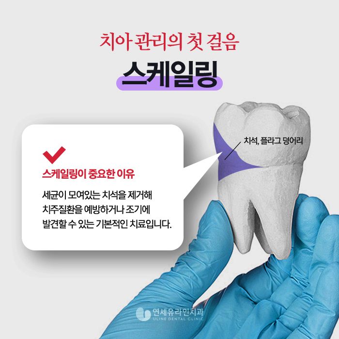 강남역 스케일링 일년에 한두번은 치과에서 관련 이미지 1