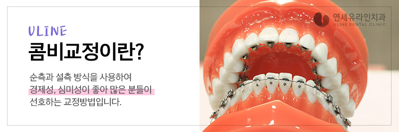 설측교정가격 하나의 우수한 심미 개선안 관련 이미지 8