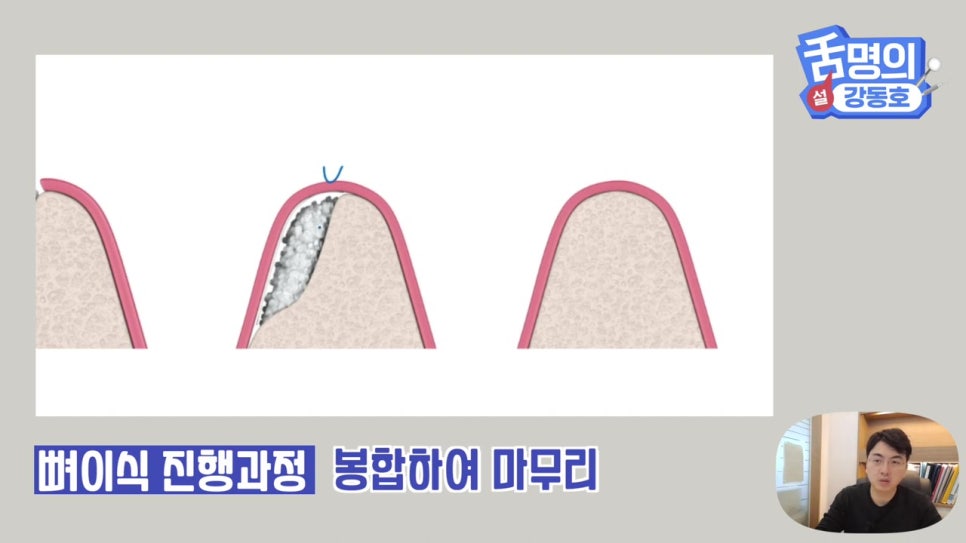 강남역임플란트, 뼈이식 왜 필요해? 관련 이미지 16