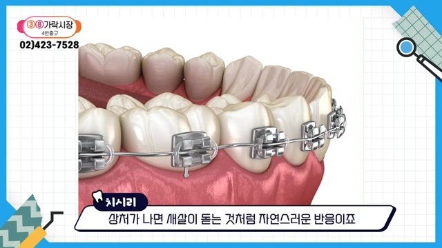 Do Braces Weaken Your Gums? A Fact Check by a Sinlim Dental Clinic image 9