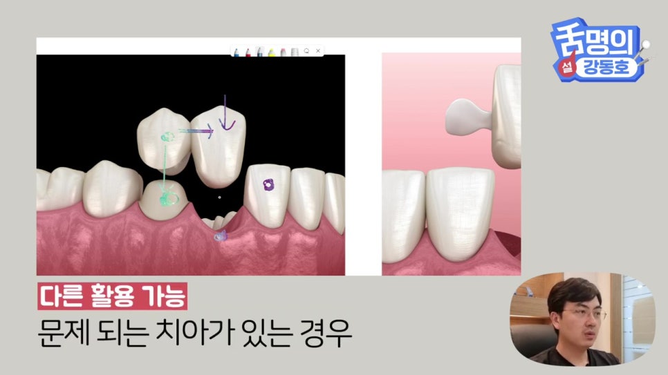신림동치과, 브릿지치료 치아삭제 부담된다면? 관련 이미지 11