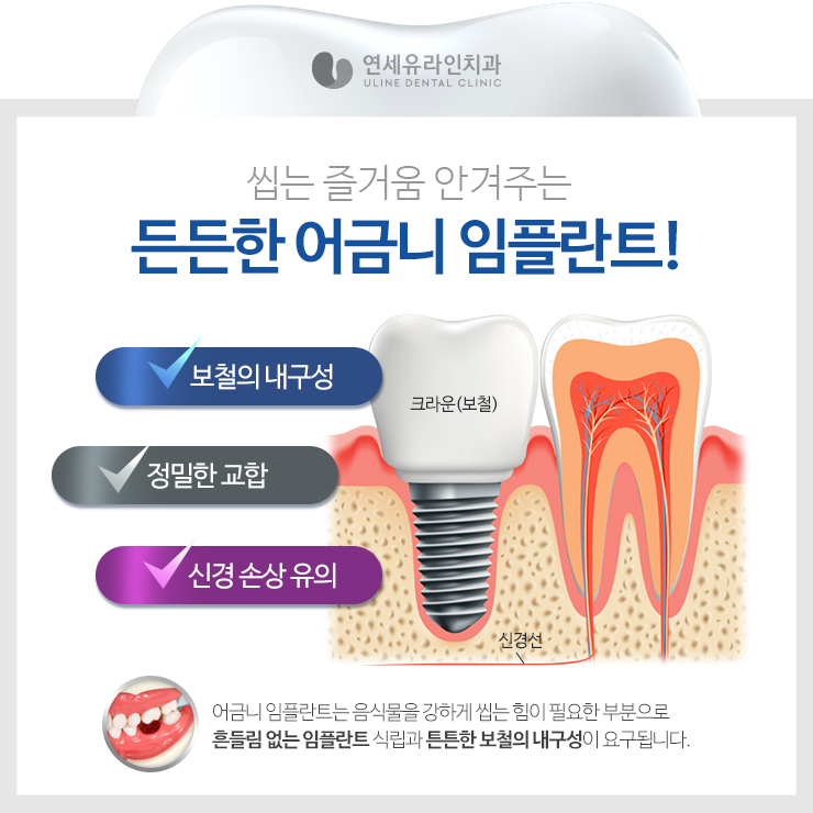 관악구치과 어금니임플란트가격대비 끝내줘 관련 이미지 4