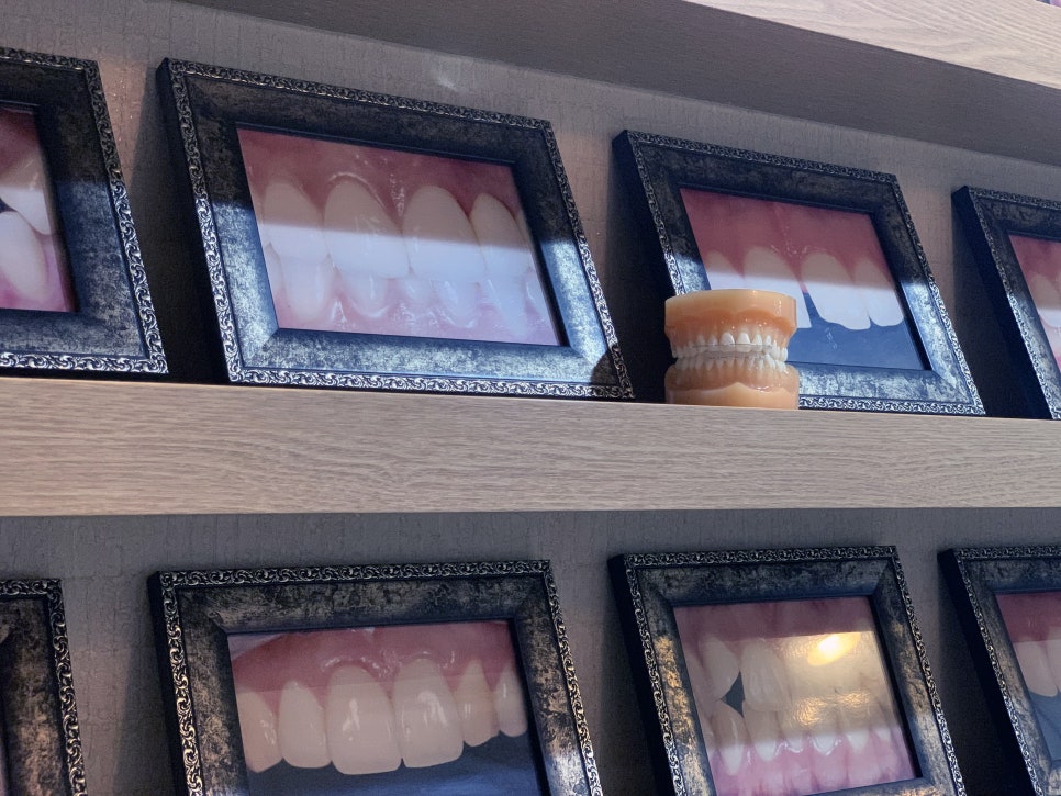 앞니부분교정기간 빨라서 감탄사 연발 관련 이미지 4