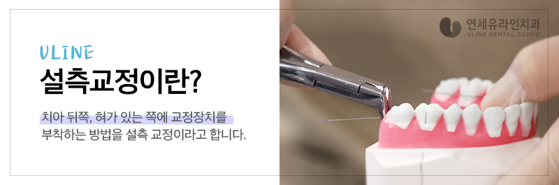 설측교정가격 하나의 우수한 심미 개선안 관련 이미지 3