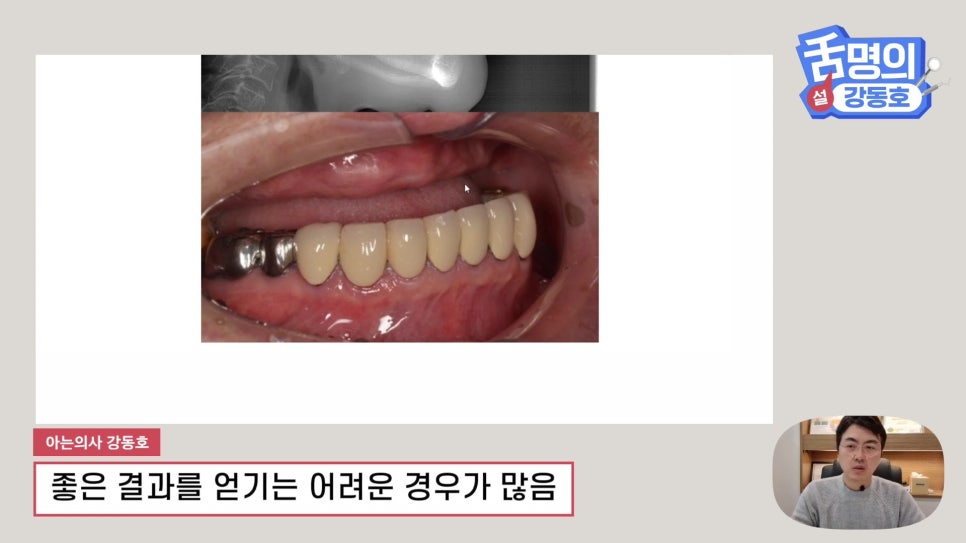 Dental Implants at Sillim Station: When There Is Not Enough Jawbone image 7