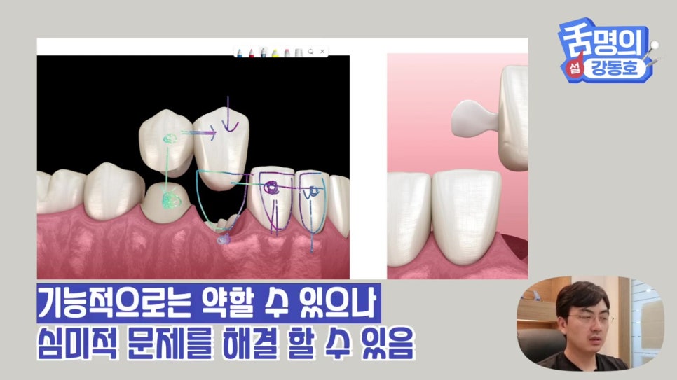 신림동치과, 브릿지치료 치아삭제 부담된다면? 관련 이미지 14