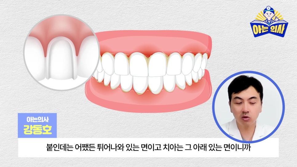무삭제라미네이트, 단점 알고해야 관련 이미지 9