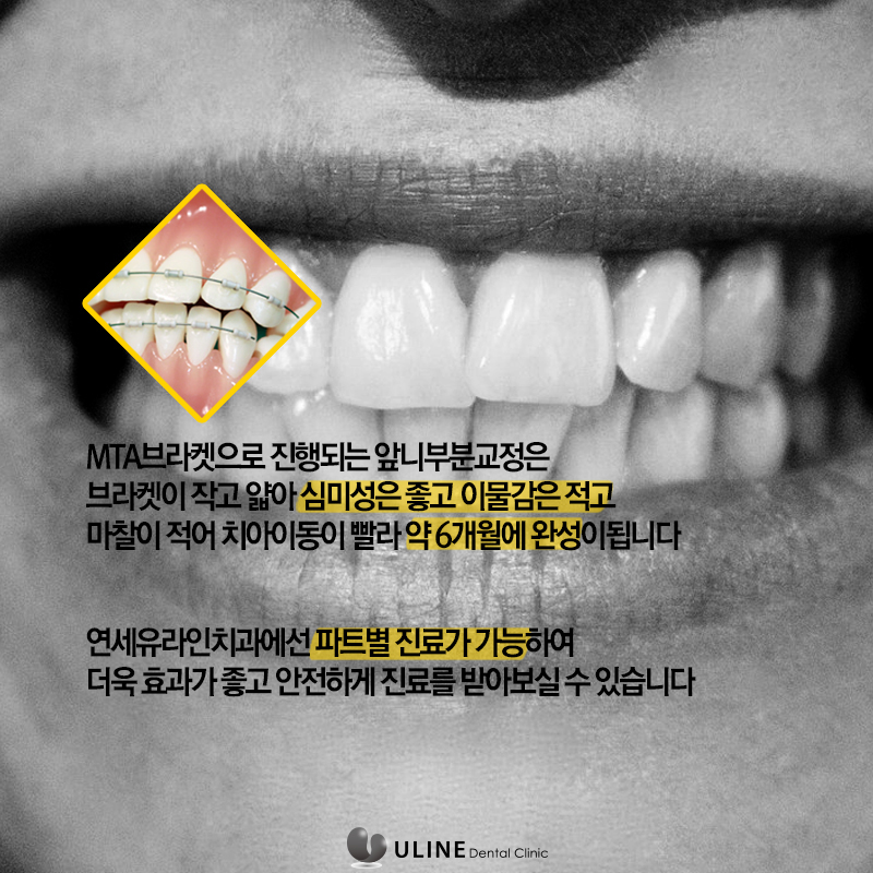돌출앞니부분교정 탈출 후기 궁그맹! 관련 이미지 9