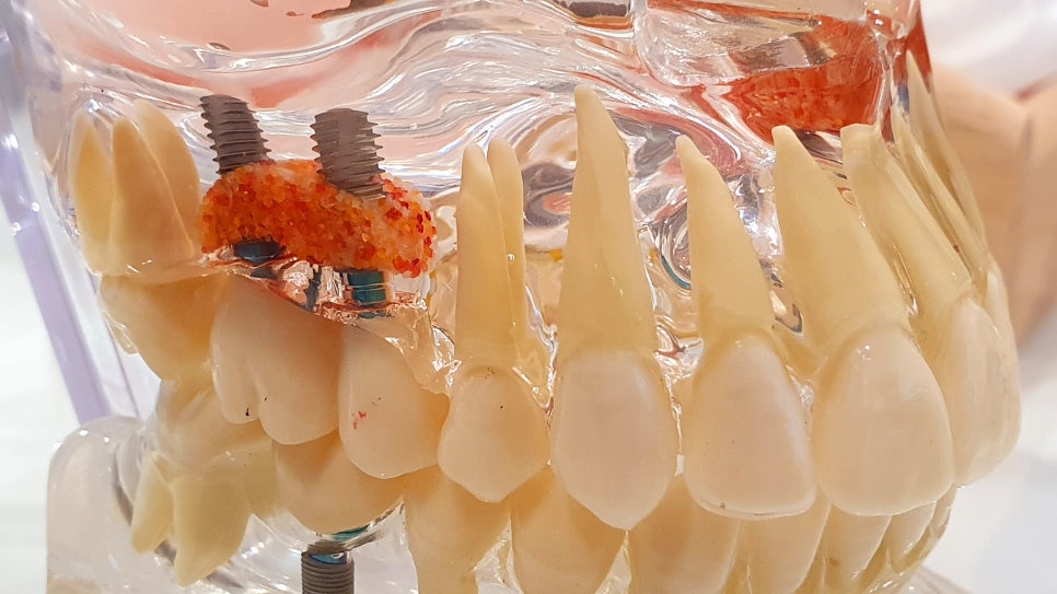 사당역치과 치아가 빠진 공간을 알맞게 채워 관련 이미지 4