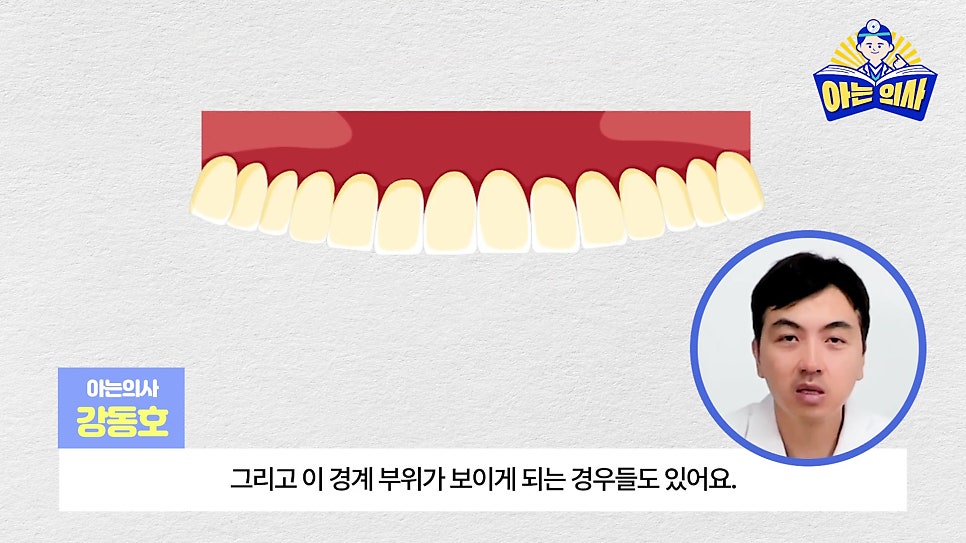 무삭제라미네이트, 단점 알고해야 관련 이미지 4