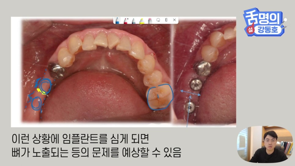 강남역임플란트, 뼈이식 왜 필요해? 관련 이미지 10
