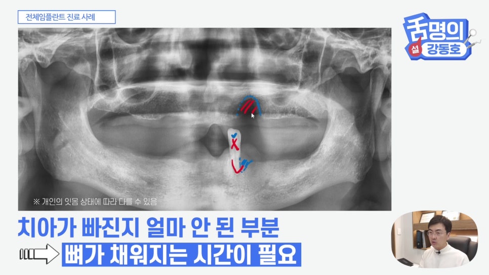관악구치과 - 전체 임플란트, 시간&middot;횟수&middot;개수 총정리 관련 이미지 10