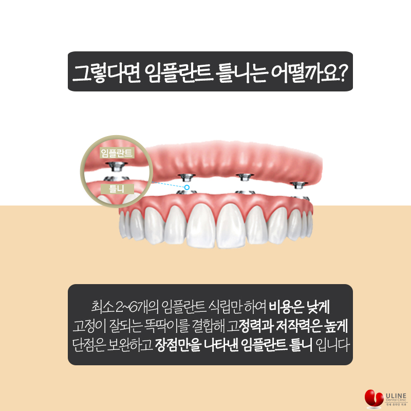 임플란트틀니비용 좋은 선택은 여기 관련 이미지 7