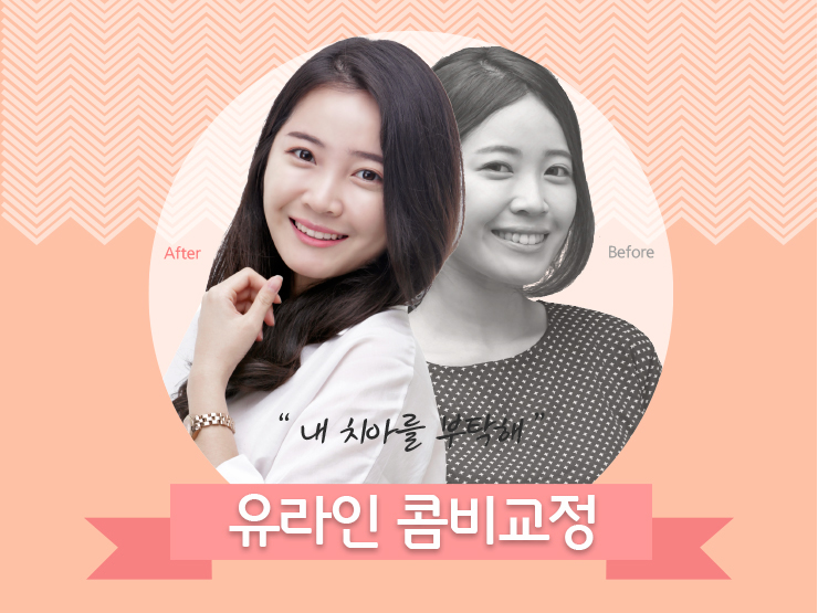 치아교정 종류 고민이시라면 이건어때요!? 관련 이미지 1