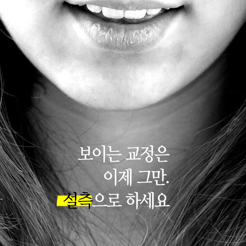 덧니설측교정 물론 가능하죠 관련 이미지 1