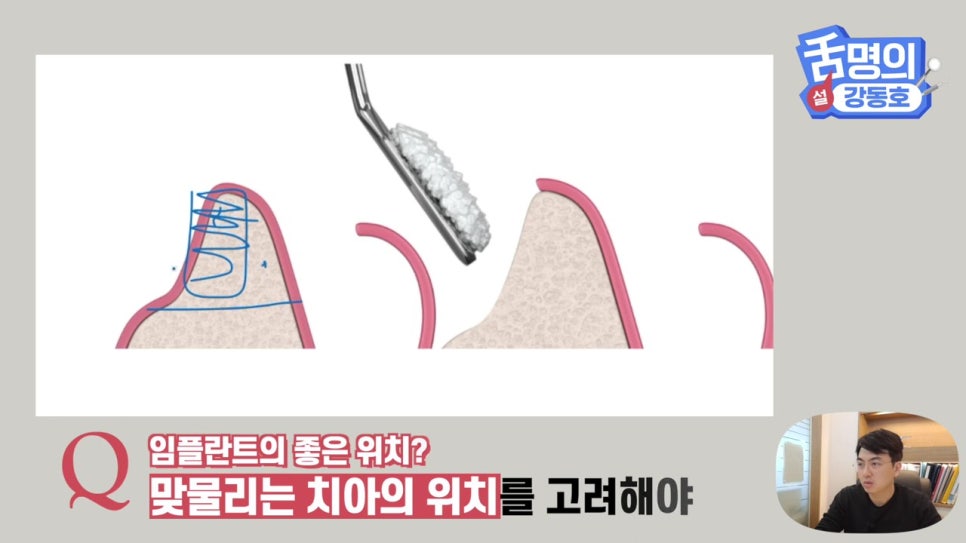 강남역임플란트, 뼈이식 왜 필요해? 관련 이미지 14