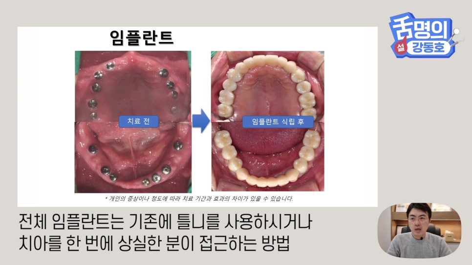 Dental Implants at Sillim Station: When There Is Not Enough Jawbone image 11