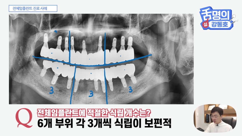 관악구치과 - 전체 임플란트, 시간&middot;횟수&middot;개수 총정리 관련 이미지 14
