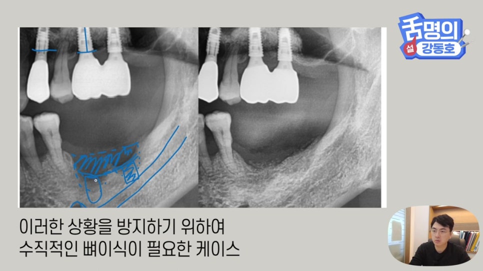 강남역임플란트, 뼈이식 왜 필요해? 관련 이미지 22