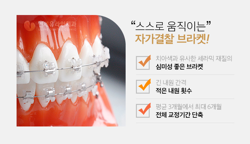 설측교정가격 하나의 우수한 심미 개선안 관련 이미지 4