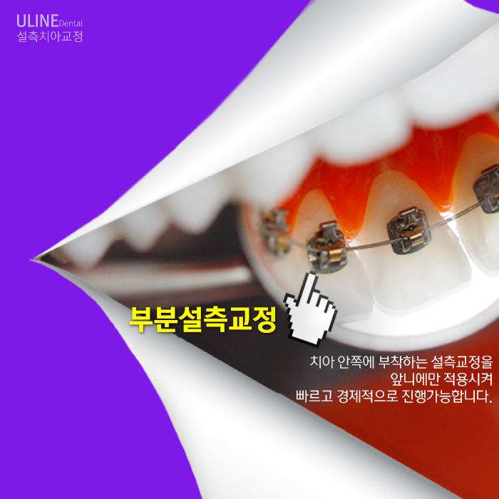 앞니부분교정후기 듣고 시작했어요! 관련 이미지 9