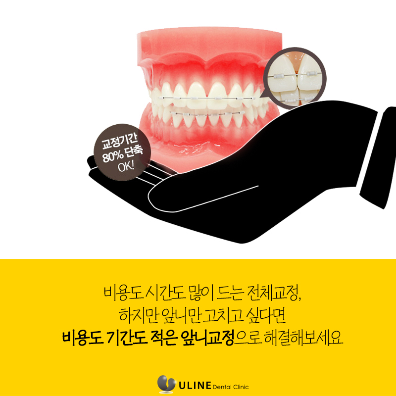 돌출앞니부분교정 탈출 후기 궁그맹! 관련 이미지 7