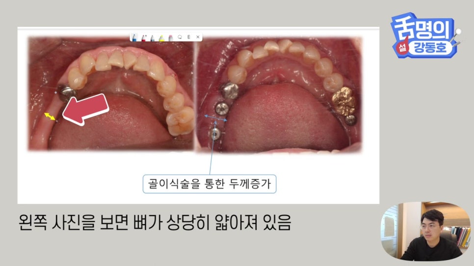 강남역임플란트, 뼈이식 왜 필요해? 관련 이미지 8