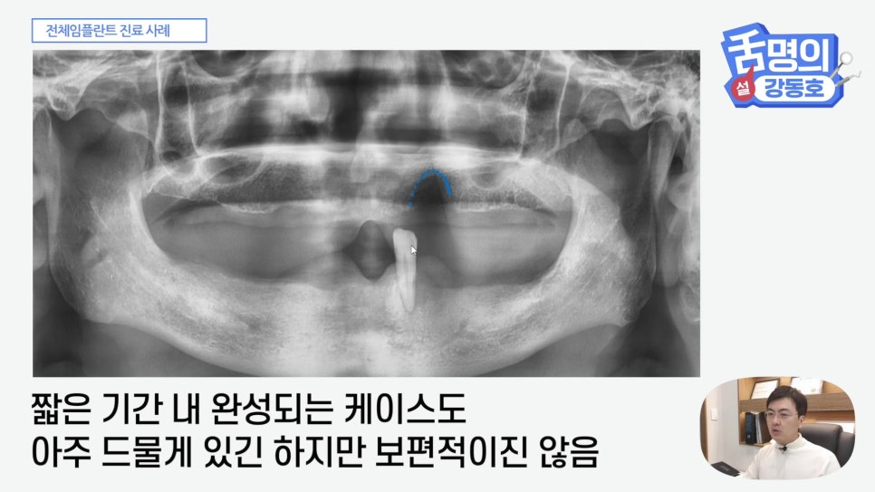 관악구치과 - 전체 임플란트, 시간&middot;횟수&middot;개수 총정리 관련 이미지 7