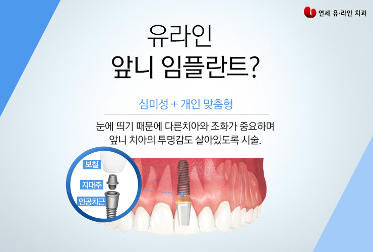 앞니임플란트가격 현명한 선택을 할 수 있는 관련 이미지 3