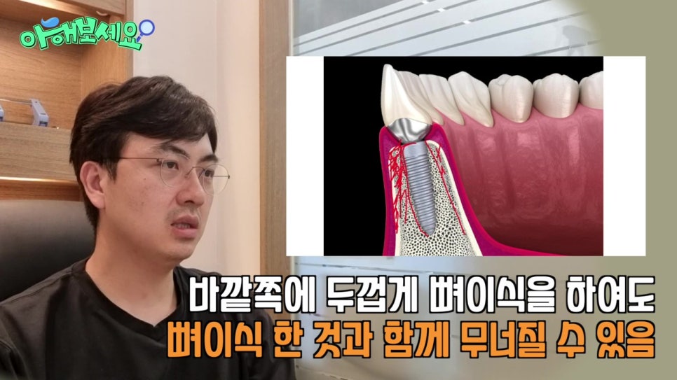 역삼역임플란트치과, 젊은층도 실패를? 관련 이미지 13