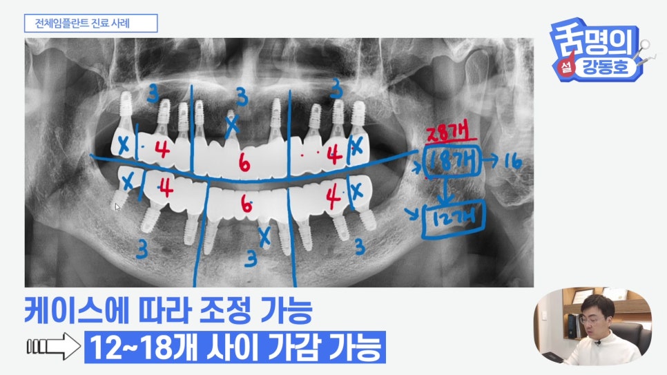 관악구치과 - 전체 임플란트, 시간&middot;횟수&middot;개수 총정리 관련 이미지 16