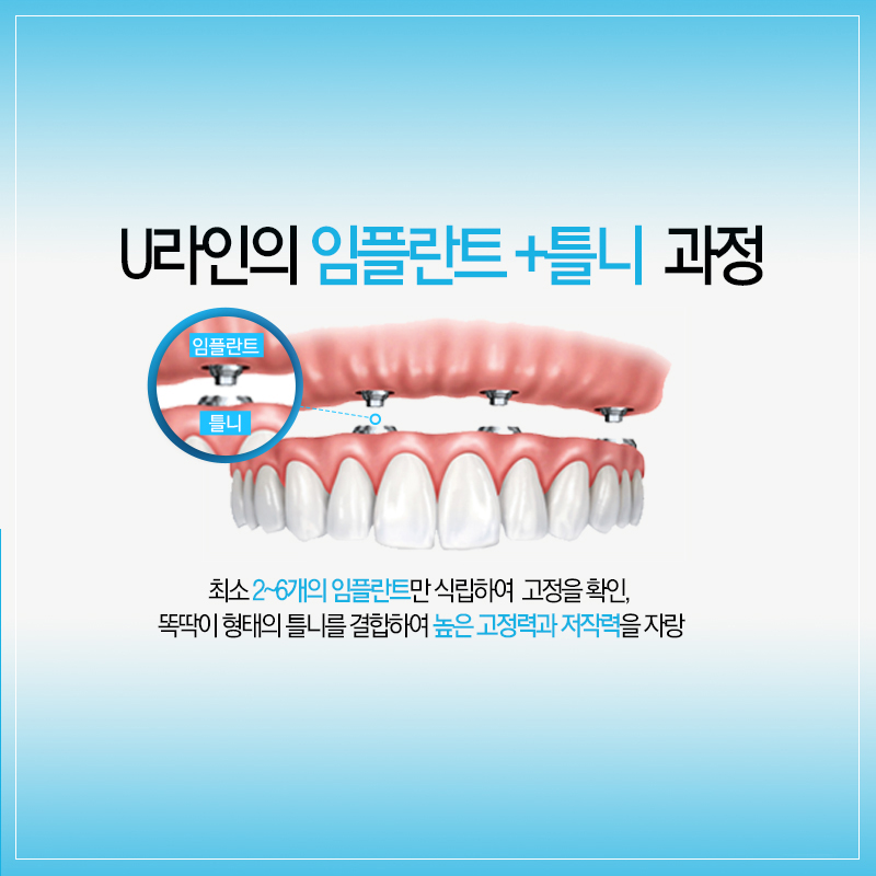 서울대입구역치과 임플란트틀니 알아보는시간 관련 이미지 4