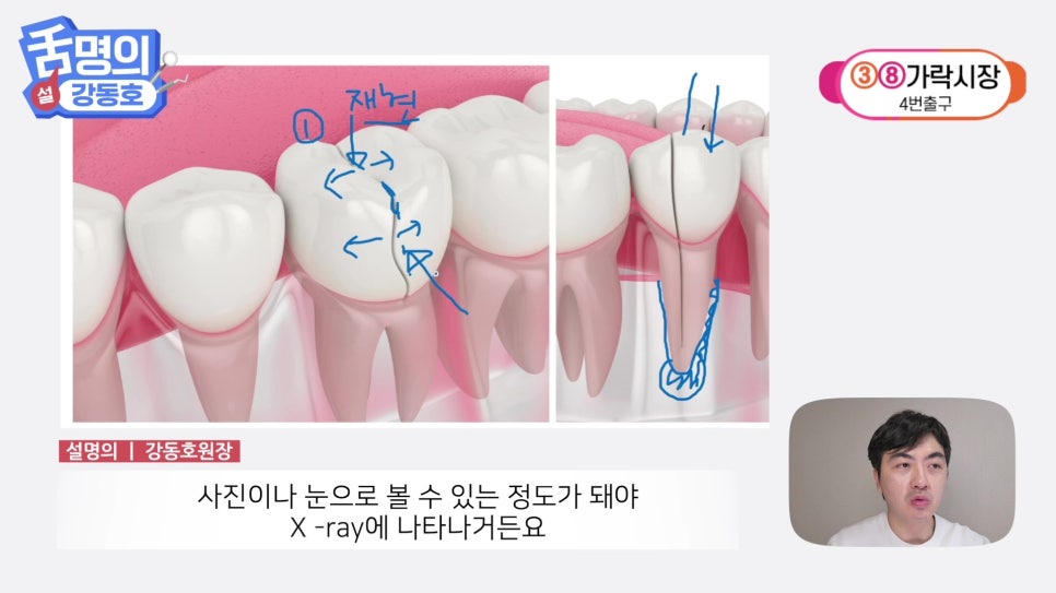 Sillim Station Dentist - Why Does It Hurt When Chewing? image 24