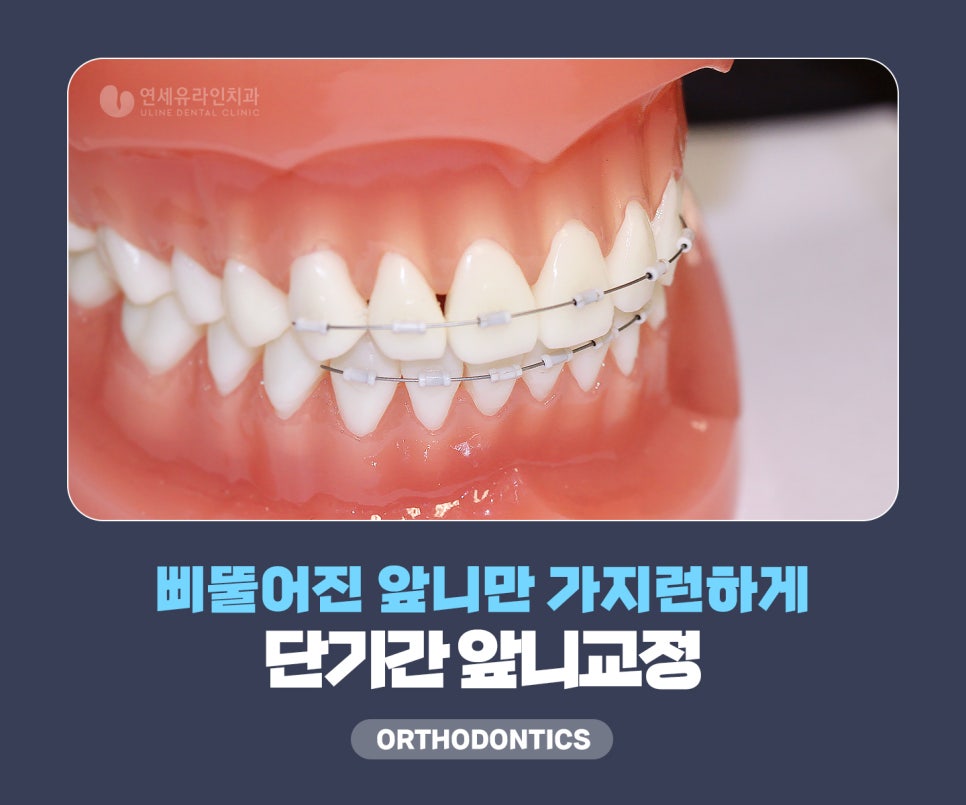 앞니부분교정기간 눈 깜짝 할 사이에! 관련 이미지 3