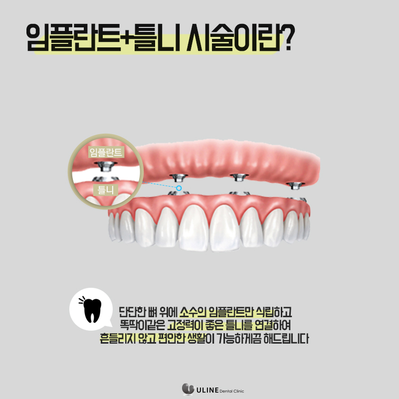 서울대입구역치과 임플란트틀니 알아보는시간 관련 이미지 7