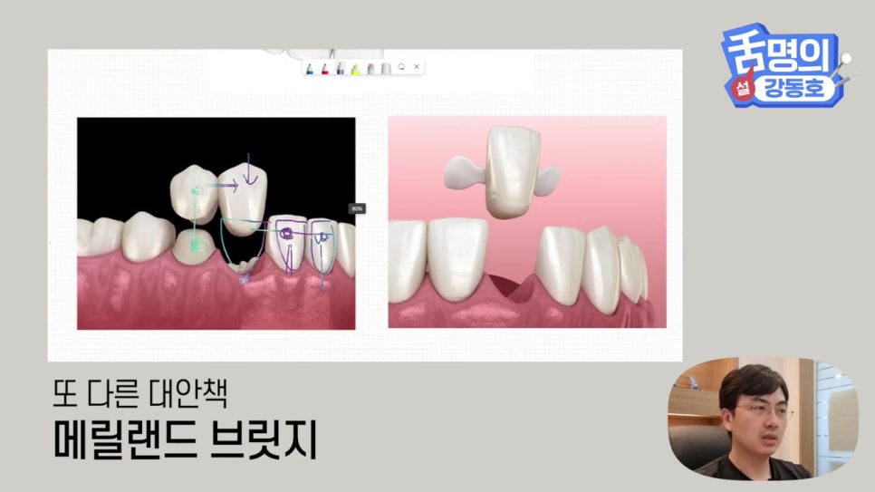 신림동치과, 브릿지치료 치아삭제 부담된다면? 관련 이미지 15