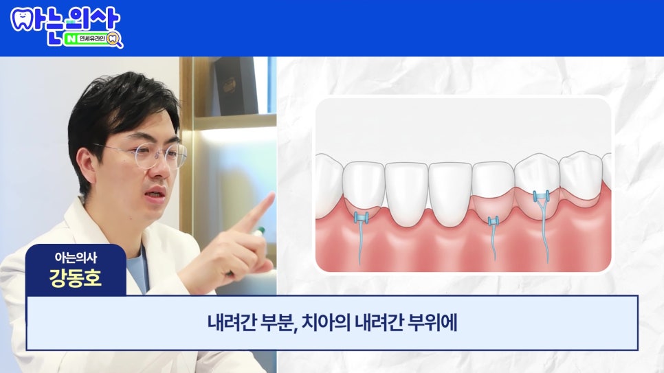 관악구 신림동치과 - 치아가 길어보이는 이유 관련 이미지 24