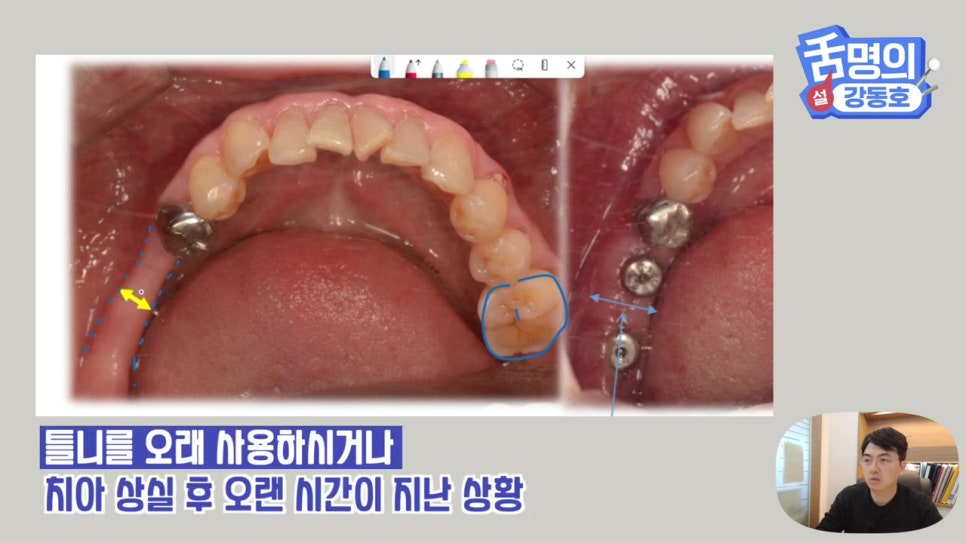 강남역임플란트, 뼈이식 왜 필요해? 관련 이미지 9